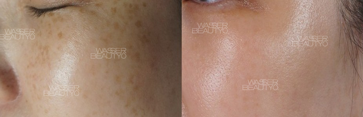 專業去斑療程前後對比, 專家分析色斑及打斑價錢, 25年經驗專業打斑推介