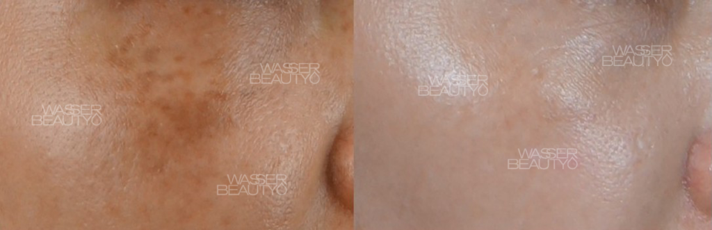 專業去斑療程前後對比, 女士臉上頑固荷爾蒙斑, 專家分析色斑及打斑價錢, 25年經驗專業打斑推介