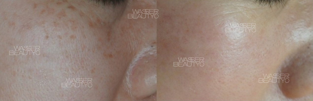 25年經驗專業打斑推介