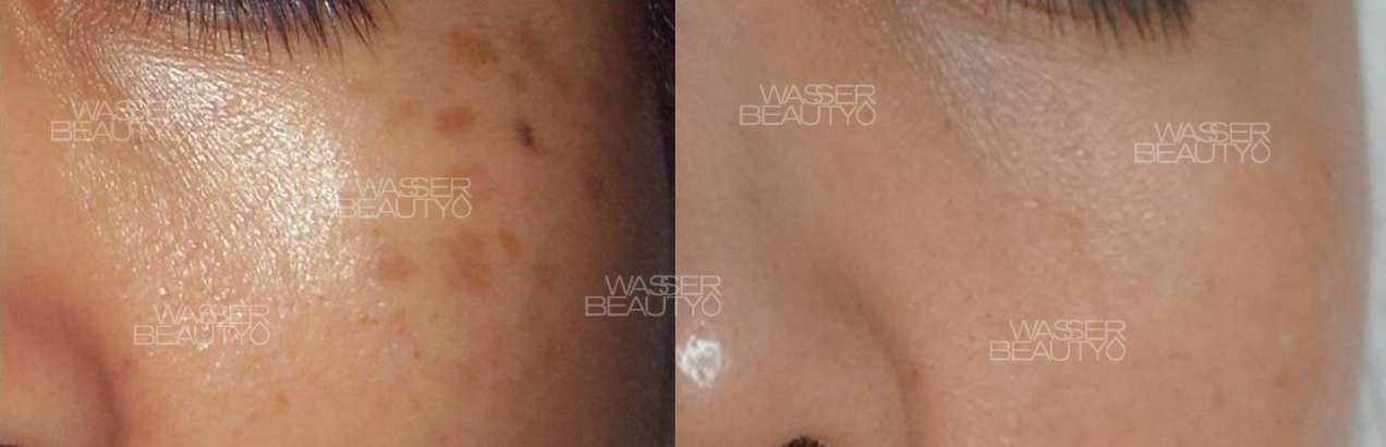 專業去斑療程前後對比, 女士臉上頑固荷爾蒙斑, 25年經驗專業打斑推介