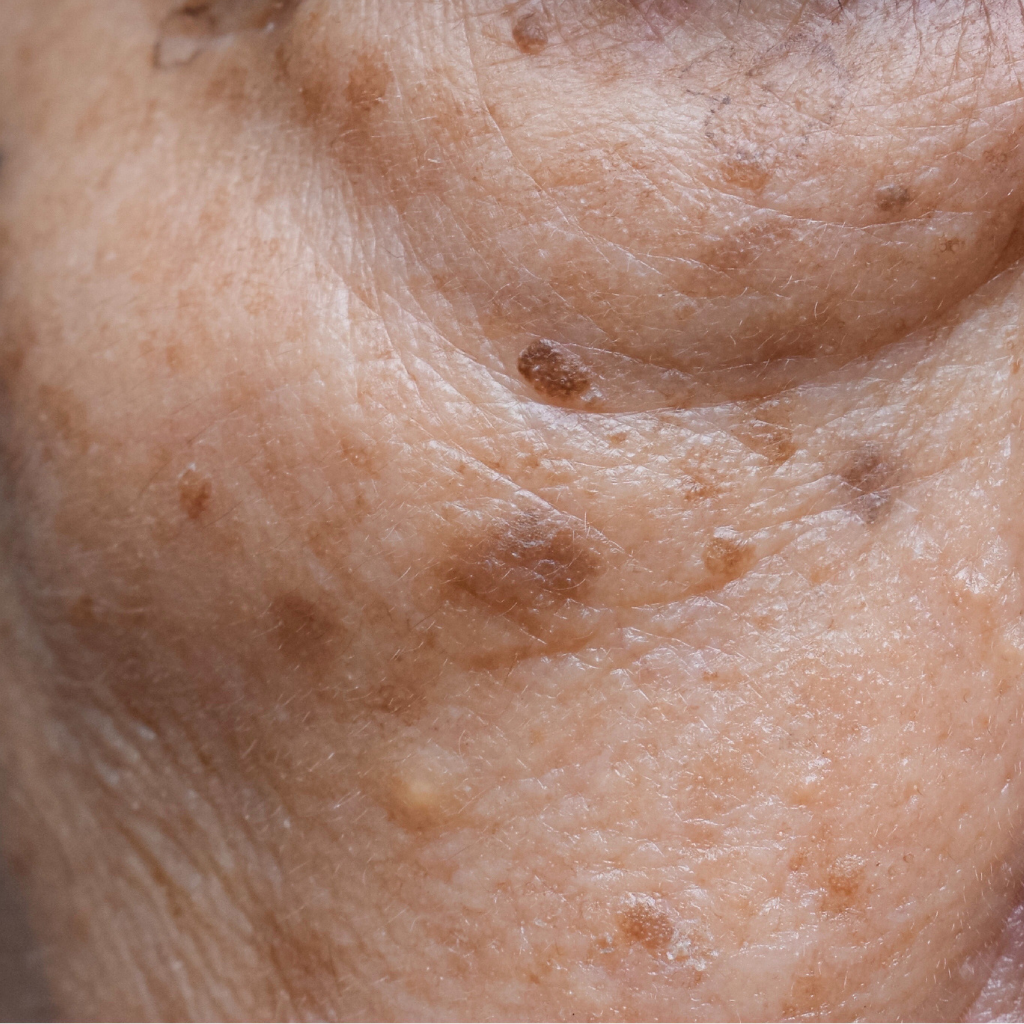 臉上老人斑的特寫