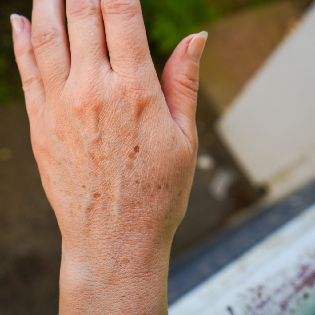 手背上的老人斑成因