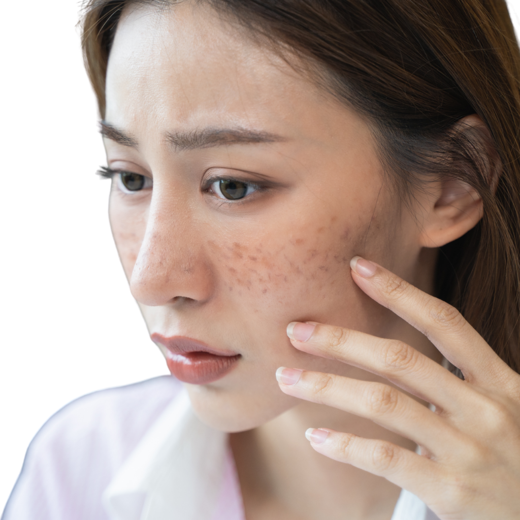 紫外線引致雀斑圖解