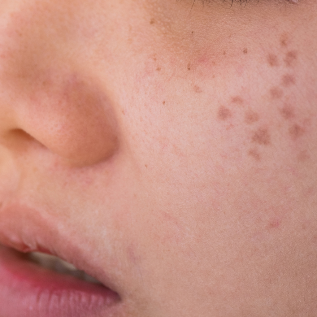 顴骨斑：深層色素的挑戰