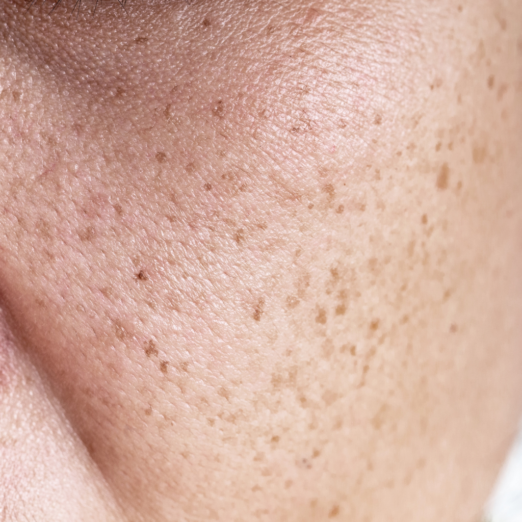 雀斑如何消除？