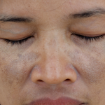 肝斑與蝴蝶斑：荷爾蒙的波動