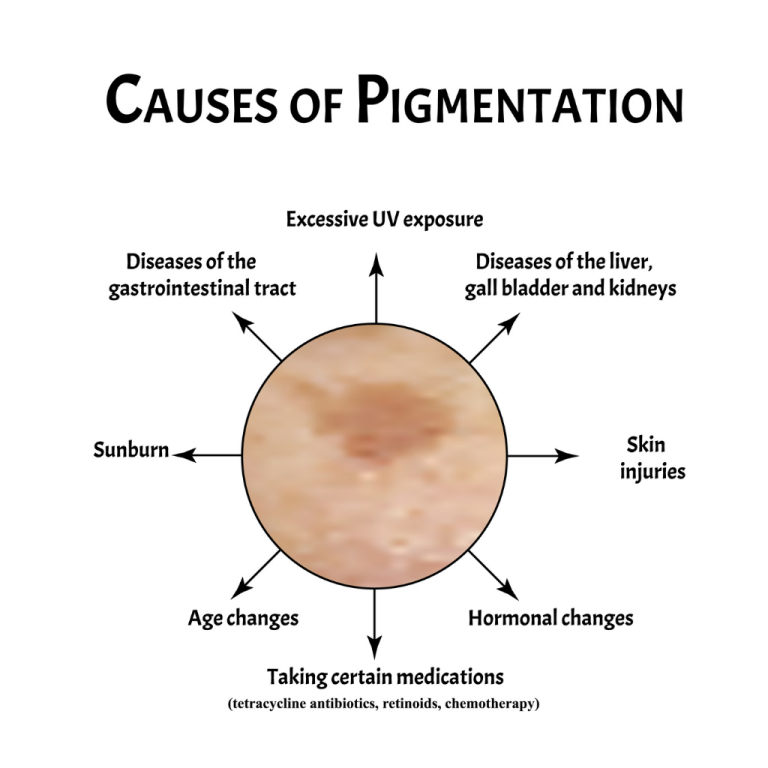 色斑的成因與類型