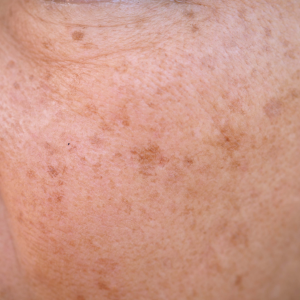 其他因素導致的色斑