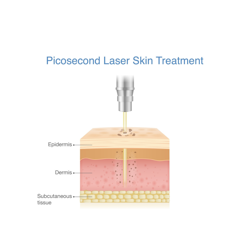 皮秒激光：新世代去老人斑的溫和高效之選