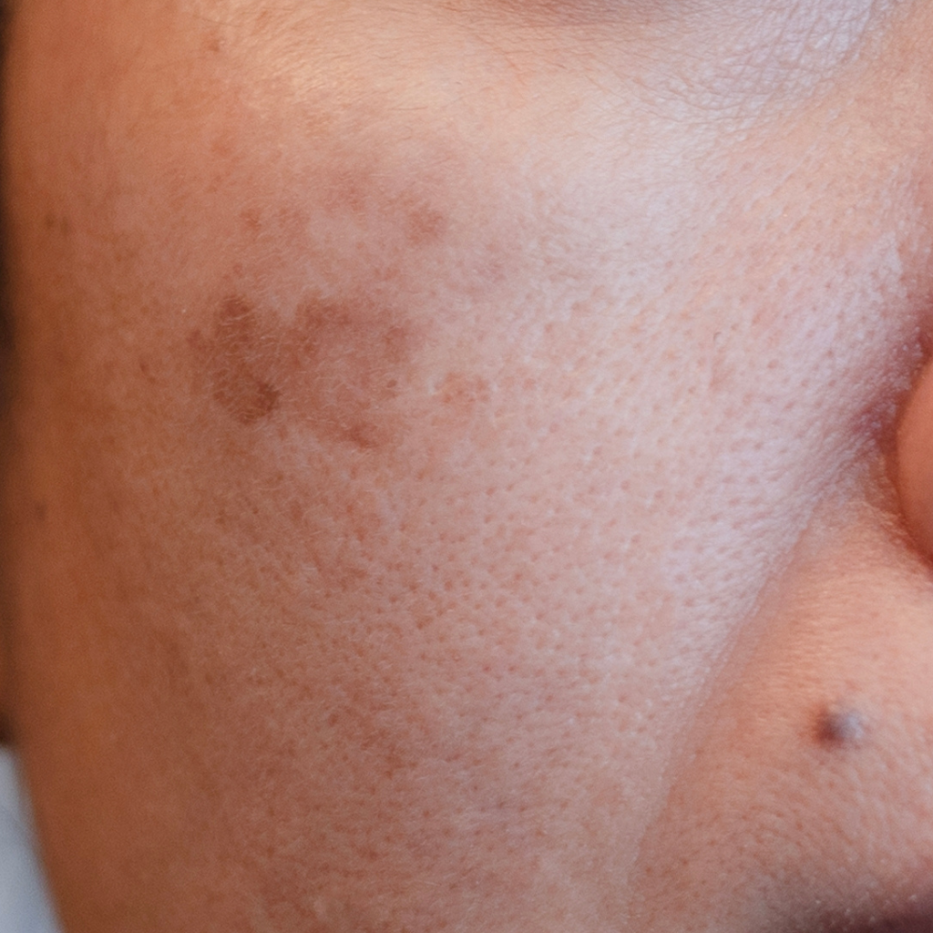 臉上老人斑的特寫