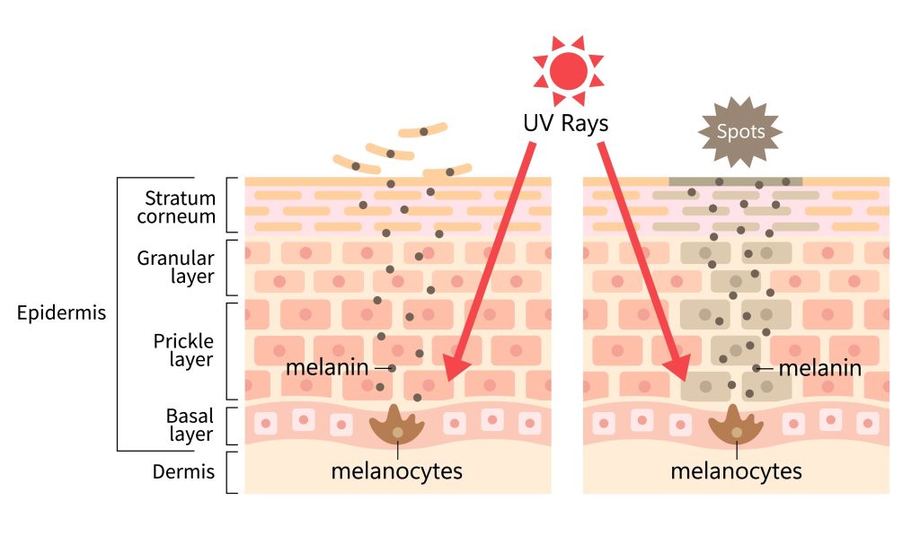 紫外線引致雀斑圖解