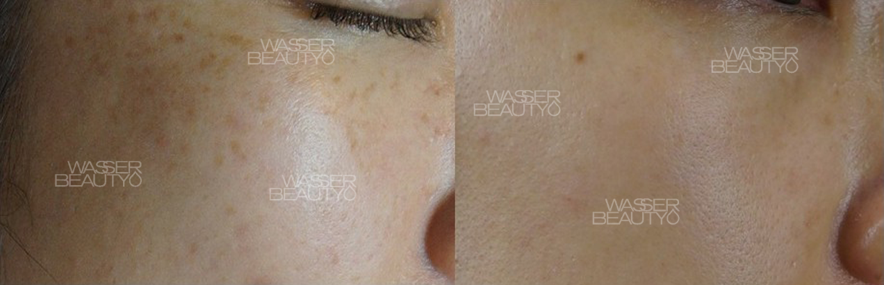 治療師分析雀斑狀況, 激光儀器消除雀斑中, 彩光去雀斑療程前後, 紫外線引致雀斑圖解, 去雀斑後肌膚顯光滑