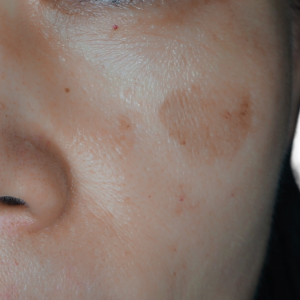 曬斑如何淡化？從根源預防到高效療程