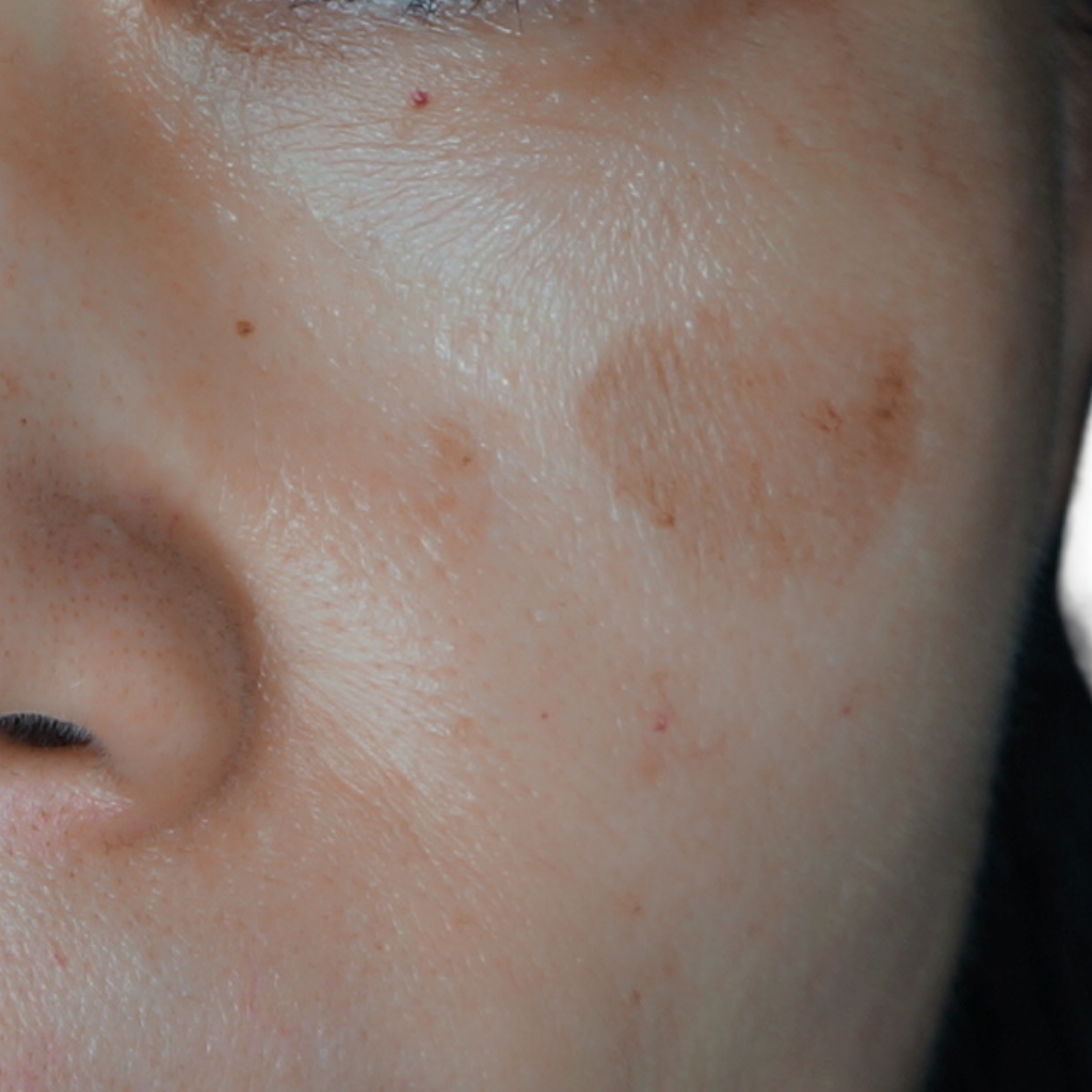 曬斑如何淡化？從根源預防到高效療程