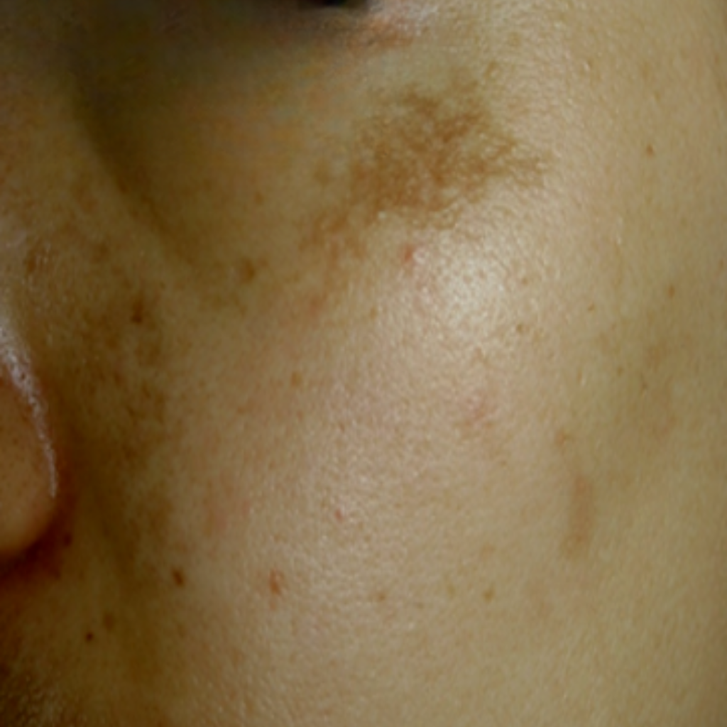 激光去斑反黑圖解, 皮秒激光震碎色斑, 預防打斑反黑護理, 皮秒激光去斑效果, 打斑反黑的皮膚層