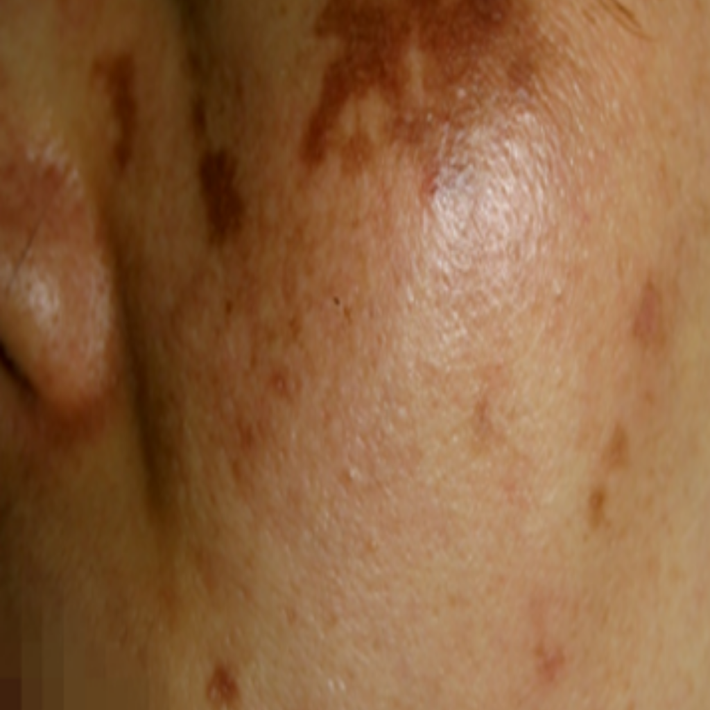 發炎後色素沉澱