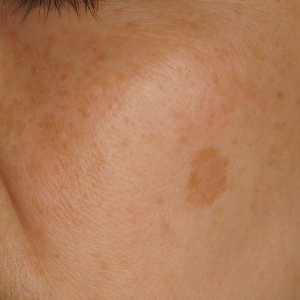 紫外線：曬太陽黑斑的元兇