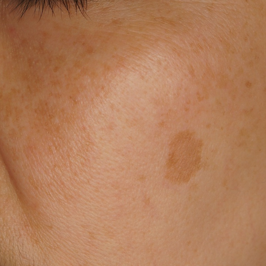 紫外線：曬太陽黑斑的元兇