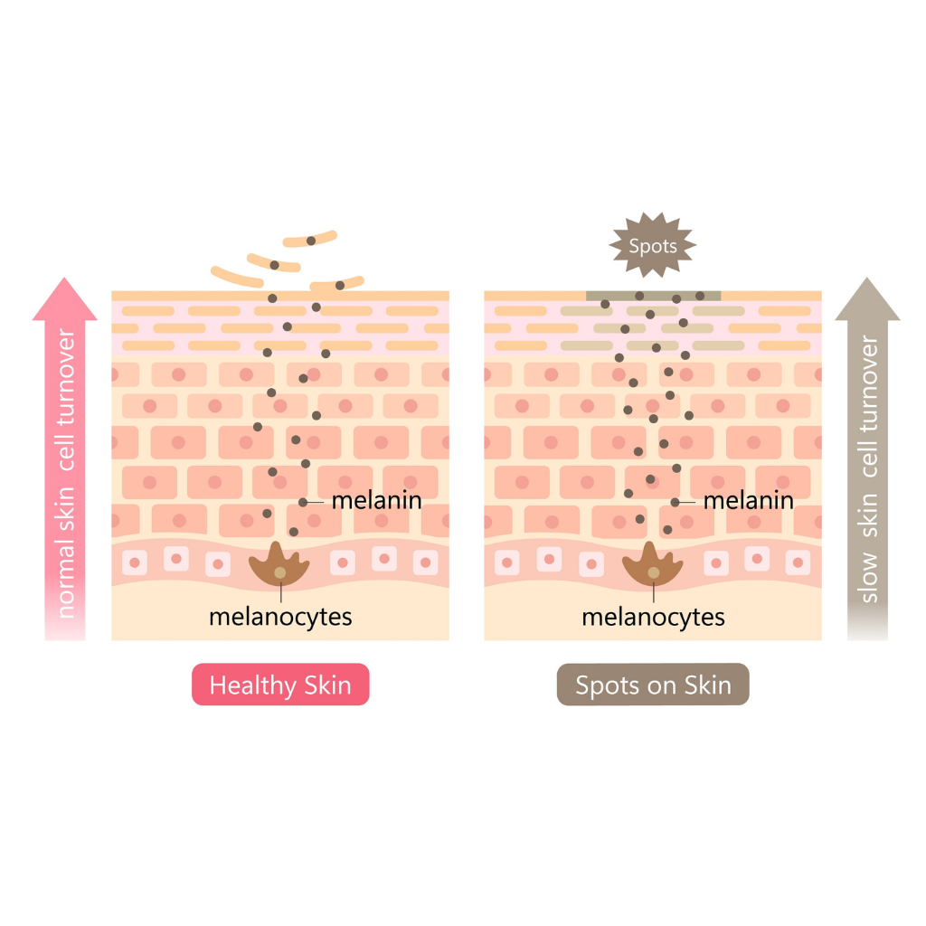 透過促進老廢角質細胞的剝落，將已經含有黑色素的細胞從皮膚表面移除，從而提亮膚色，淡化斑點