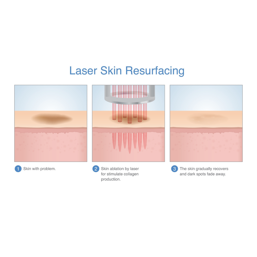 現代醫美科技, 精準擊退老人斑的激光療法
