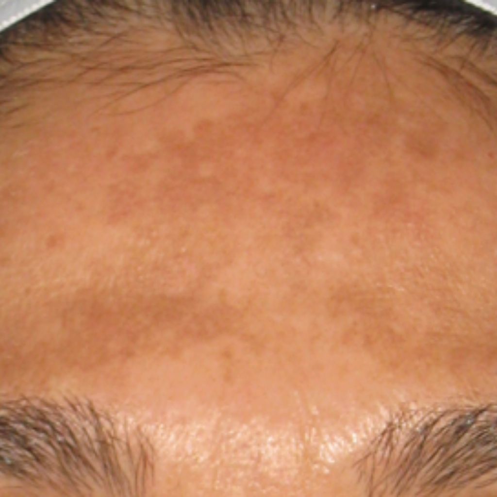 激光去斑反黑圖解, 皮秒激光震碎色斑, 預防打斑反黑護理, 皮秒激光去斑效果, 打斑反黑的皮膚層