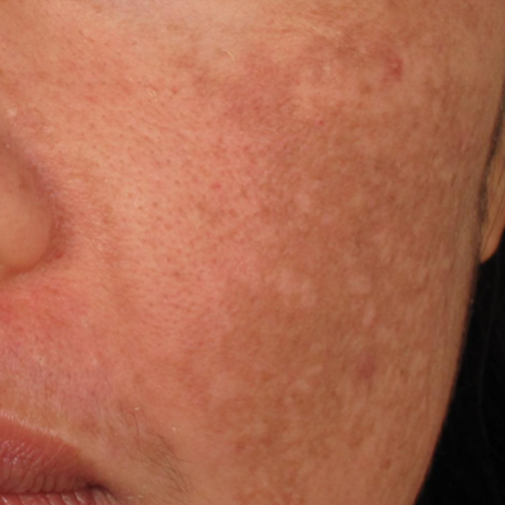 雞尾酒式去荷爾蒙斑, 臉上頑固的荷爾蒙斑, 深層色斑的皮膚圖示