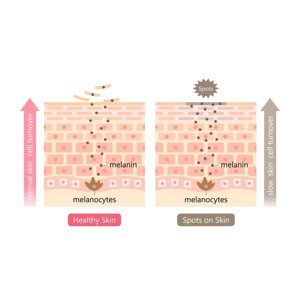 透過促進老廢角質細胞的剝落，將已經含有黑色素的細胞從皮膚表面移除，從而提亮膚色，淡化斑點