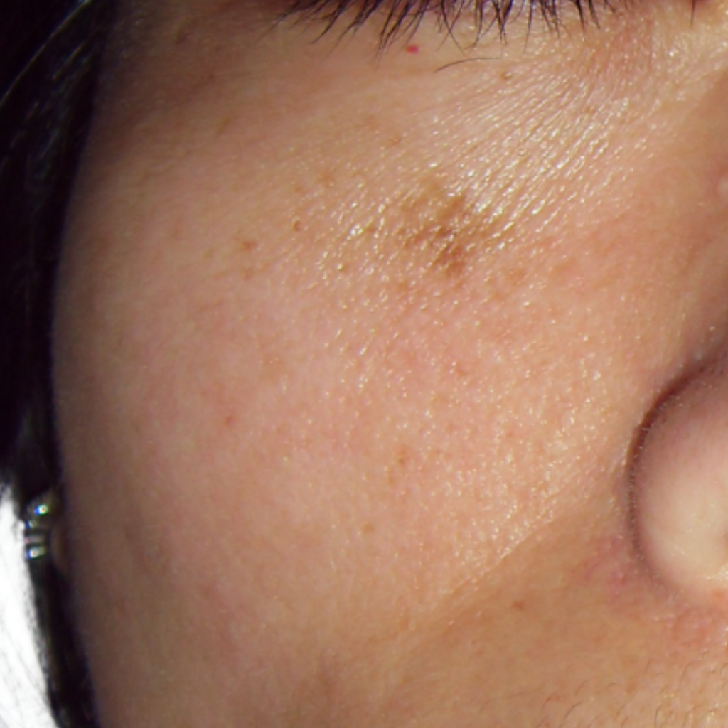 曬斑的成因與預防之道