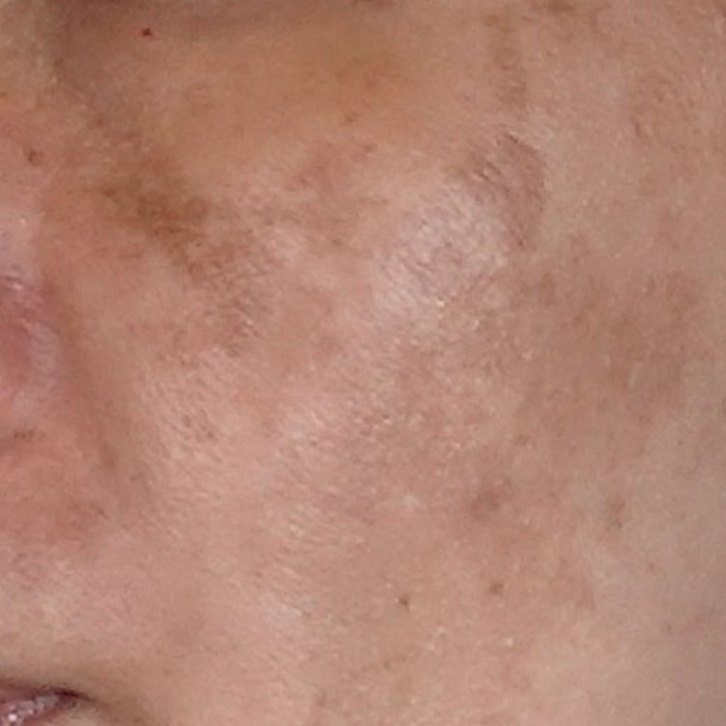 荷爾蒙斑，醫學上稱之為黃褐斑，是一種後天性色素沉著過度疾病