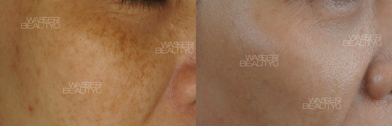 一位中年女士在接受Wasser Beauty的專業去斑療程前後的對比圖,臉上頑固的荷爾蒙斑明顯減淡,膚色變得均勻亮白。
