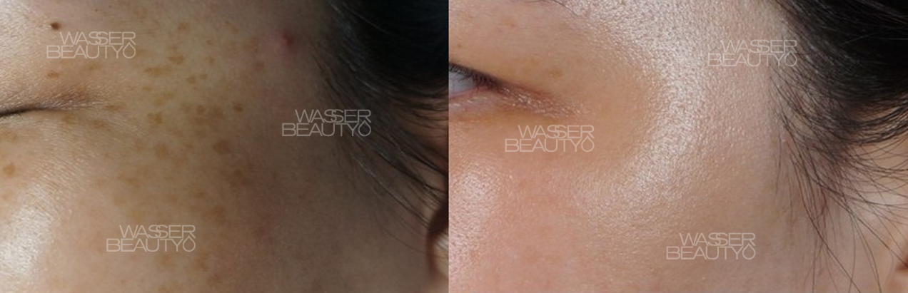 治療師分析雀斑狀況, 激光儀器消除雀斑中, 彩光去雀斑療程前後, 紫外線引致雀斑圖解, 去雀斑後肌膚顯光滑