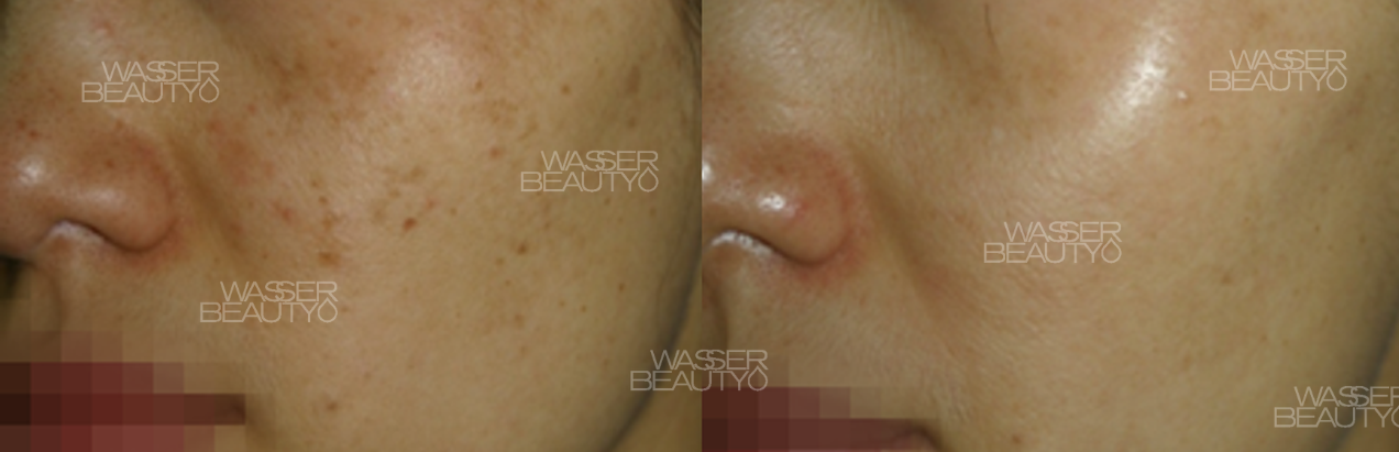 一位中年女士在接受Wasser Beauty的專業去斑療程前後的對比圖,臉上頑固的荷爾蒙斑明顯減淡,膚色變得均勻亮白