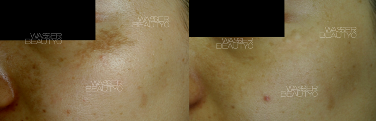 激光去斑反黑圖解, 皮秒激光震碎色斑, 預防打斑反黑護理, 皮秒激光去斑效果, 打斑反黑的皮膚層