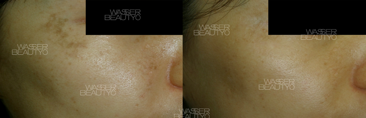 激光去斑反黑圖解, 皮秒激光震碎色斑, 預防打斑反黑護理, 皮秒激光去斑效果, 打斑反黑的皮膚層