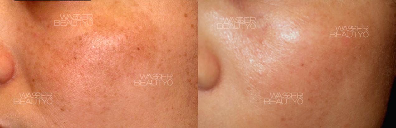 激光去斑反黑圖解, 皮秒激光震碎色斑, 預防打斑反黑護理, 皮秒激光去斑效果, 打斑反黑的皮膚層