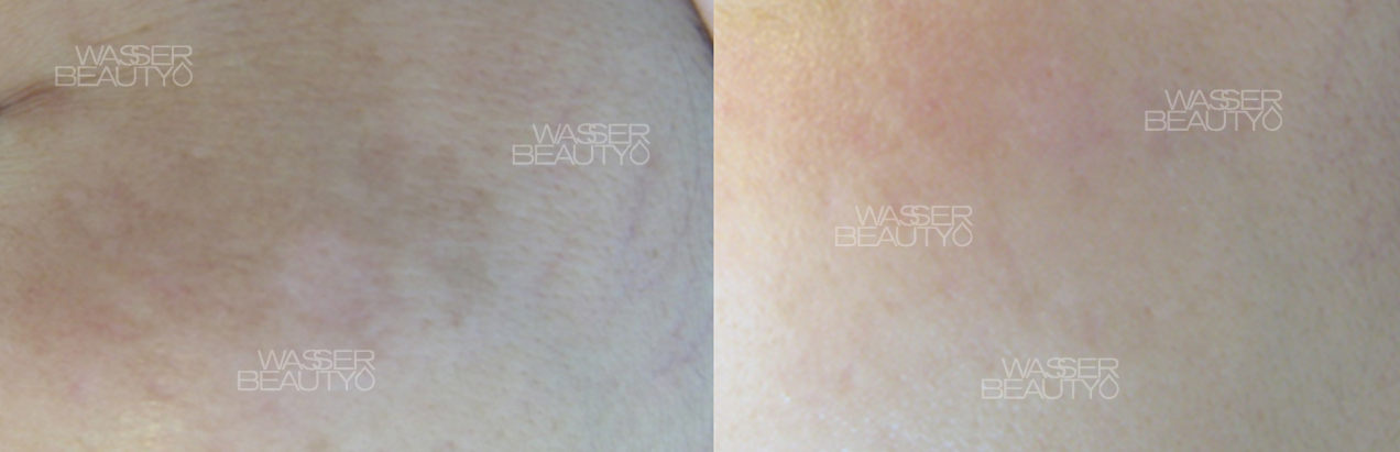 激光去斑反黑圖解, 皮秒激光震碎色斑, 預防打斑反黑護理, 皮秒激光去斑效果, 打斑反黑的皮膚層