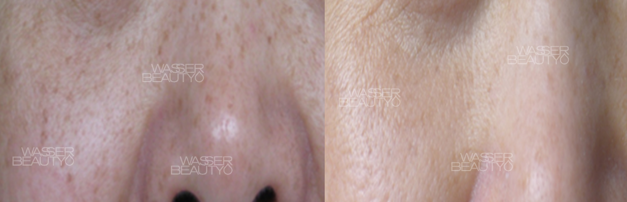 治療師分析雀斑狀況, 激光儀器消除雀斑中, 彩光去雀斑療程前後, 紫外線引致雀斑圖解, 去雀斑後肌膚顯光滑