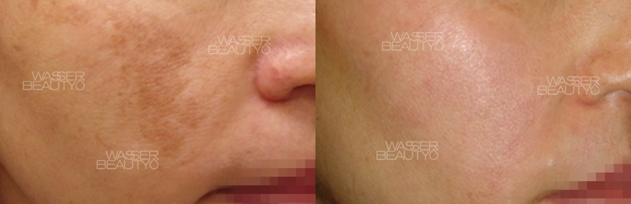 激光去斑反黑圖解, 皮秒激光震碎色斑, 預防打斑反黑護理, 皮秒激光去斑效果, 打斑反黑的皮膚層