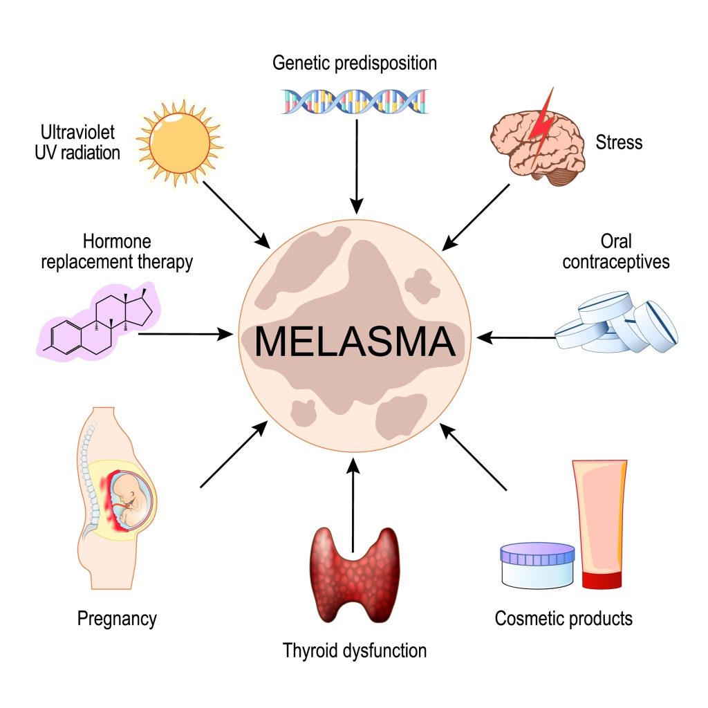 荷爾蒙斑的成因與特性