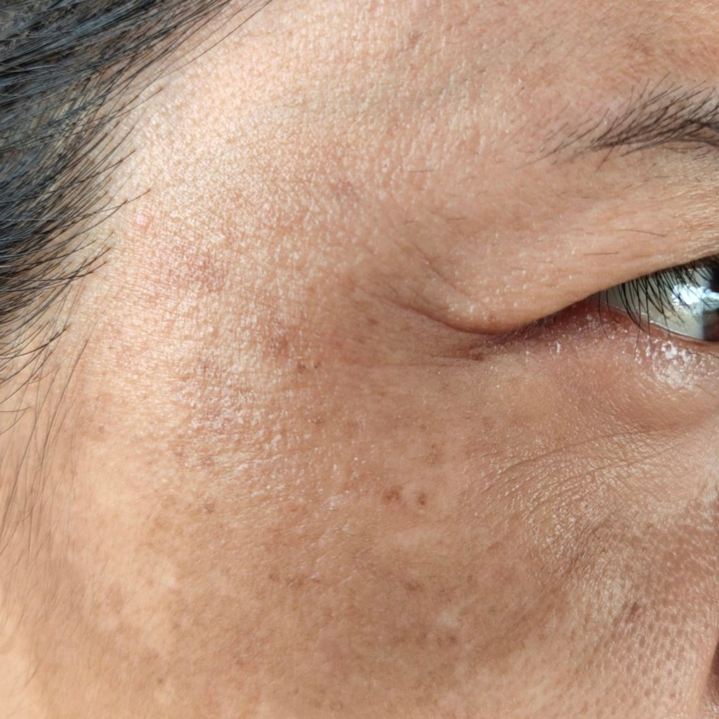 荷爾蒙斑，醫學上稱之為黃褐斑，是一種後天性色素沉著過度疾病