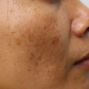 荷爾蒙斑，醫學上稱之為黃褐斑，是一種後天性色素沉著過度疾病