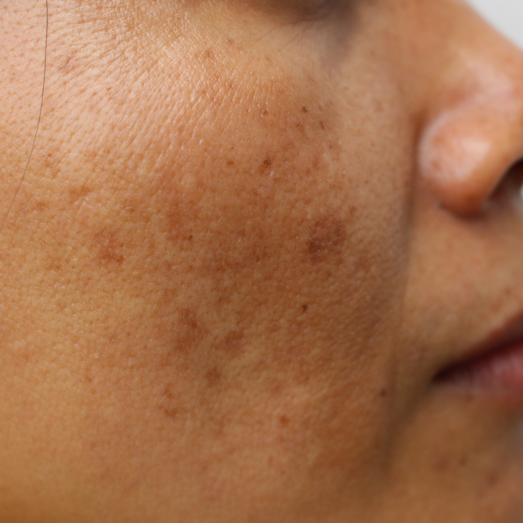 荷爾蒙斑，醫學上稱之為黃褐斑，是一種後天性色素沉著過度疾病