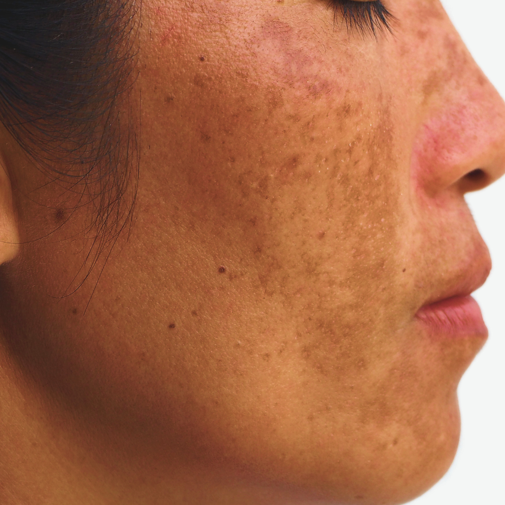 荷爾蒙斑，醫學上稱之為黃褐斑，是一種後天性色素沉著過度疾病