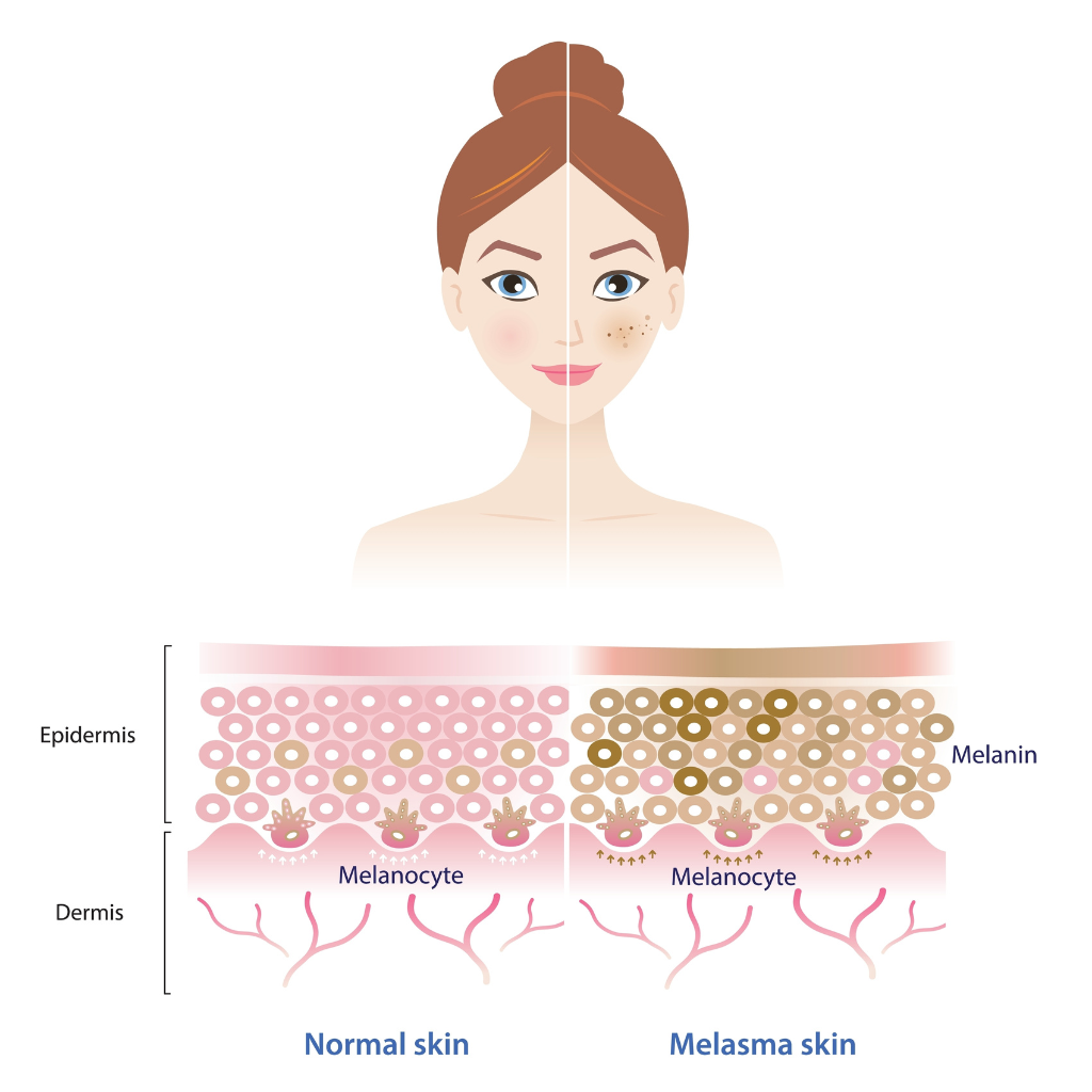 荷爾蒙斑的成因