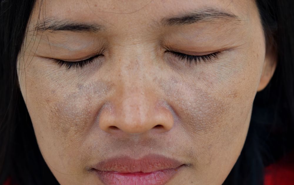 典型特徵是在臉部形成黃褐色或灰褐色的對稱斑片