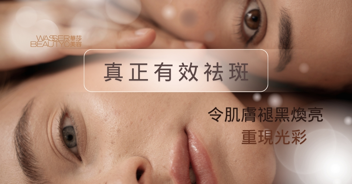 顴骨斑原因詳解, 激光去顴痣斑, 頑固顴骨斑治療, 專業分析色斑, 告別深層色斑