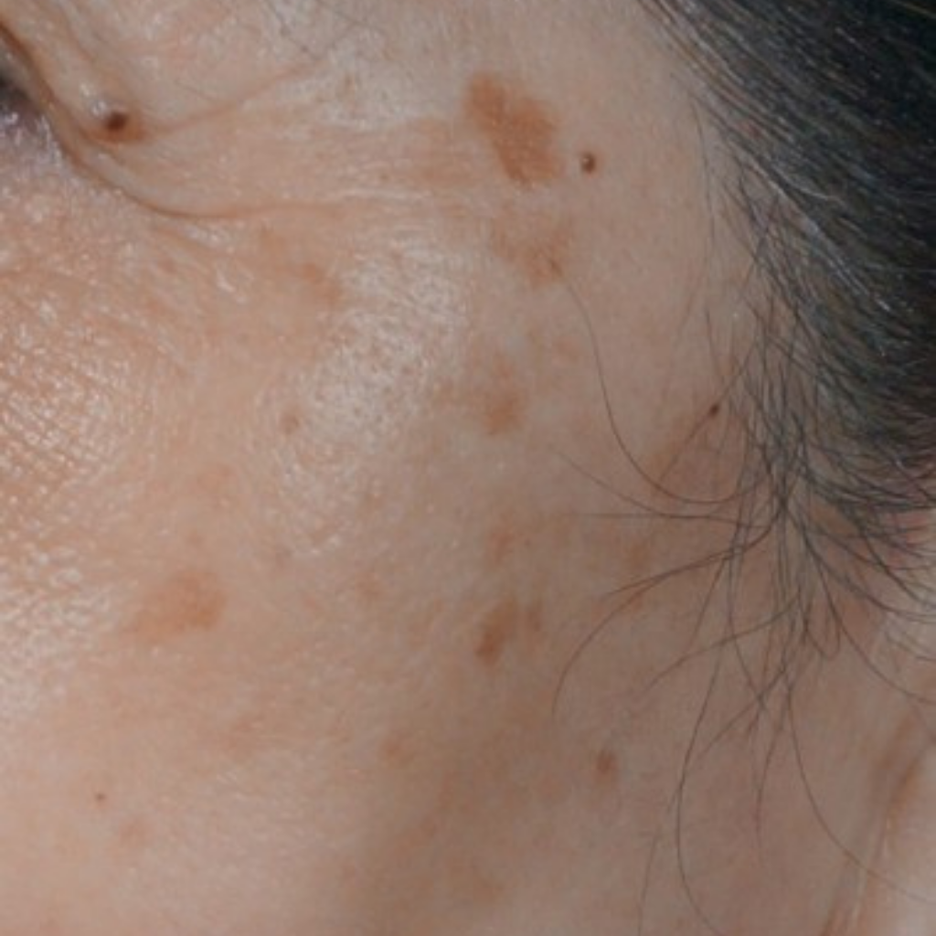 曬斑如何淡化？從根源預防到高效療程