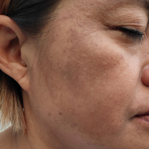 臉頰上的對稱肝斑, 紫外線引發肝斑成因, 專業肝斑治療諮詢, 肝斑治療前後對比, 肝斑色素沉澱示意圖