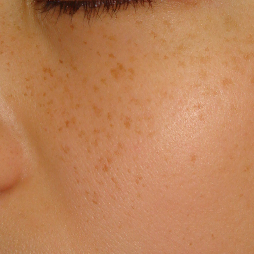 紫外線致色斑成因, 專業美容師色斑治療, 皮秒激光去斑儀器