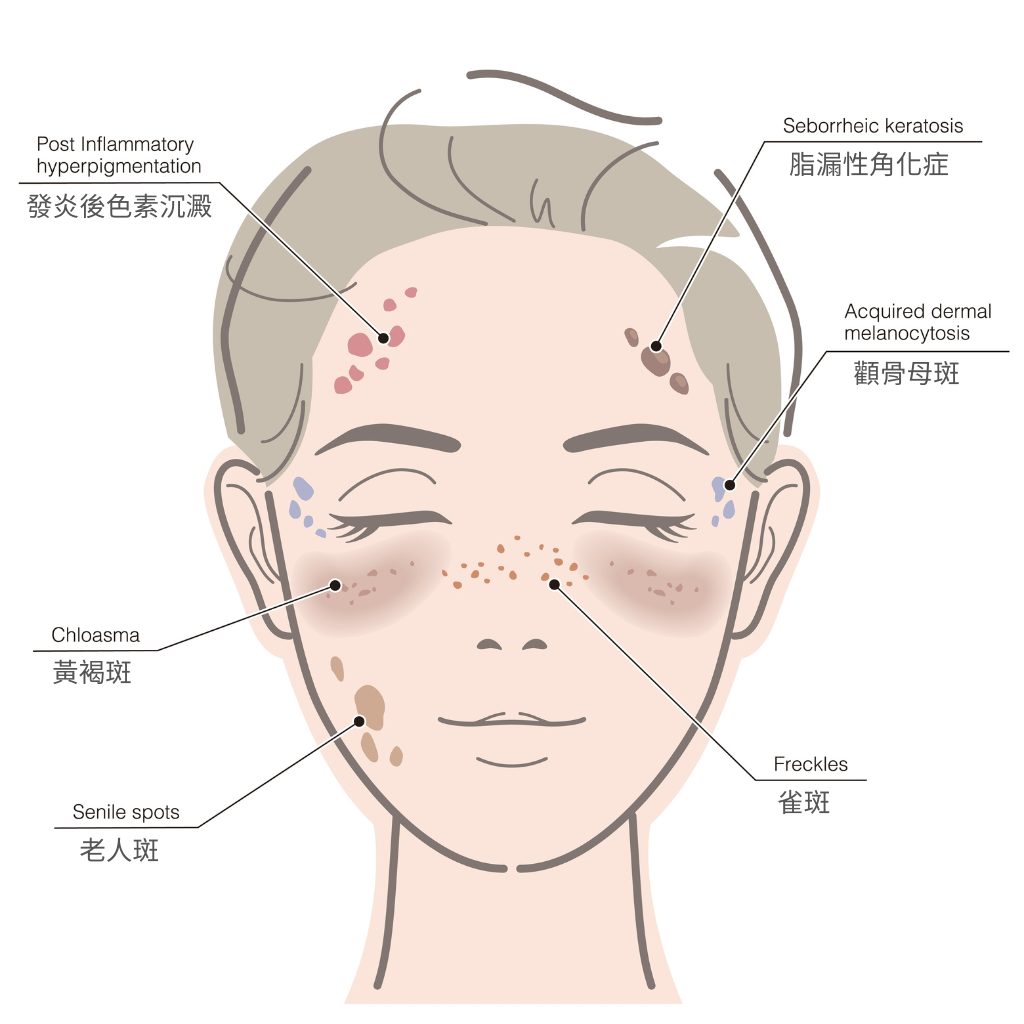 各種面部色斑種類, 紫外線致色斑成因, 專業美容師色斑治療, 皮秒激光去斑儀器, 荷爾蒙斑治療效果